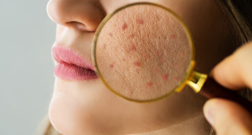 Impurità della pelle: come affrontarla in autunno